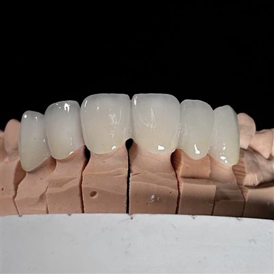 Apakah kekuatan ikatan zirkonia gigi dan e.max kepada struktur gigi?